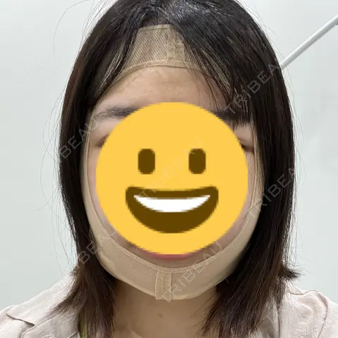 糸リフト / バッカルファット除去 / 脂肪吸引（顔） / ヒアルロン酸注入（あご） / ボトックス（エラ・小顔） アリエル美容クリニック 大宮院 DAY 0