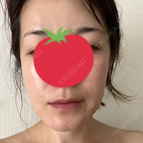 糸リフト 東京ロイヤルクリニック AFTER
