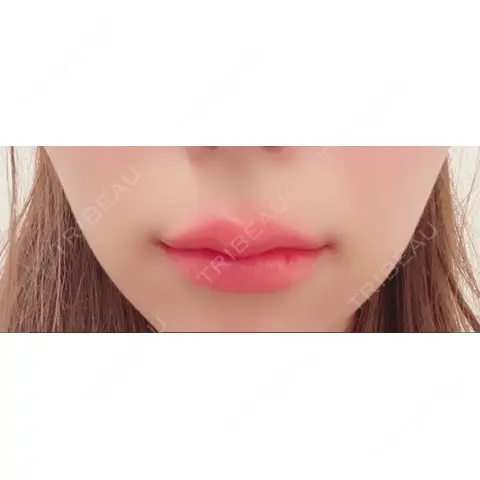 ボトックス（あご） / ヒアルロン酸注入（唇） / ボトックス（口角） / ボトックス（人中） MAe Clinic 東京院 DAY 0