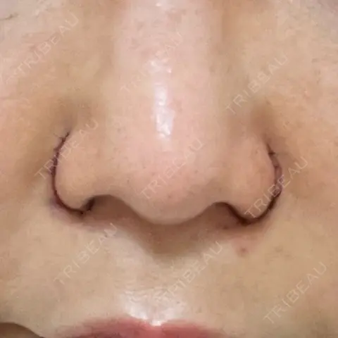 小鼻縮小（切開） / 鼻翼挙上 MIL CLINIC OSAKA DAY 0