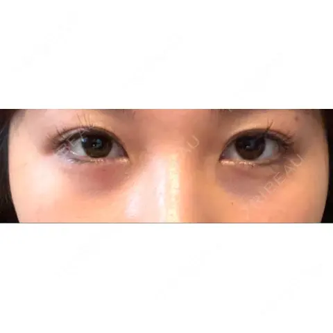 クマ治療 / 下まぶたの脂肪取り APOLLO BEAUTY CLINIC DAY 0