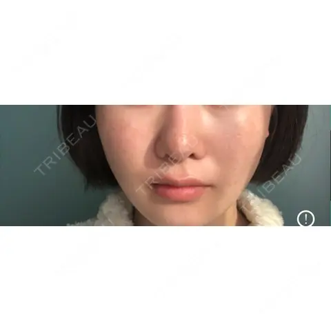 隆鼻術 / 鼻尖形成（切開） / 小鼻縮小（切開） / 軟骨移植 フェアクリニック川口 AFTER