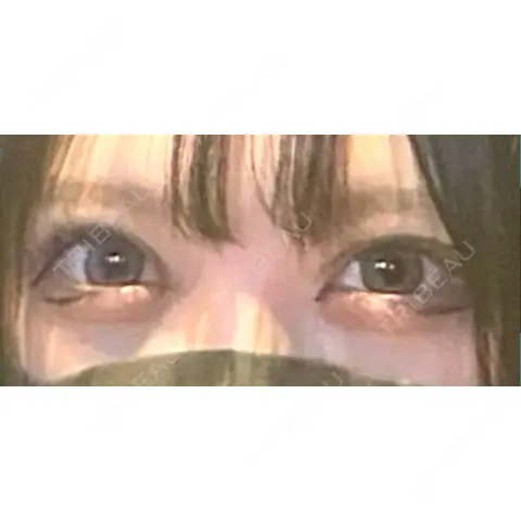 二重切開 東京エビスクリニック AFTER