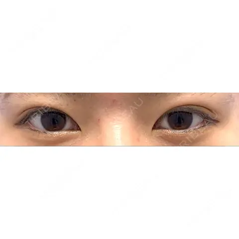 二重埋没 / 上まぶたの脂肪取り 湘南美容クリニック 上野院 AFTER