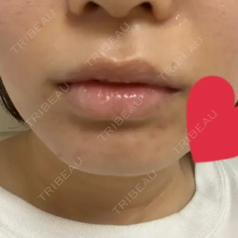 ヒアルロン酸注入（唇） YBC横浜美容外科 大宮院 AFTER