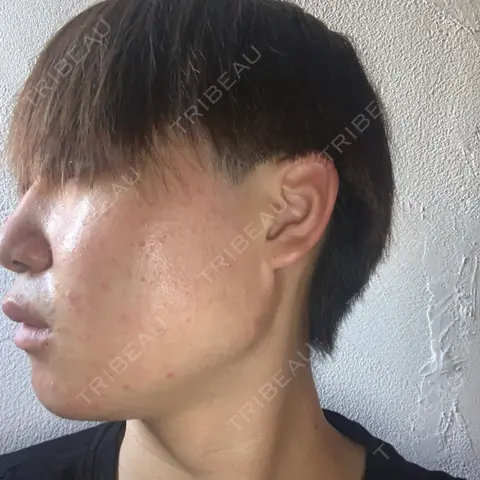 脂肪溶解注射（顔） MSC LUNA CLINIC 渋谷院 DAY 1