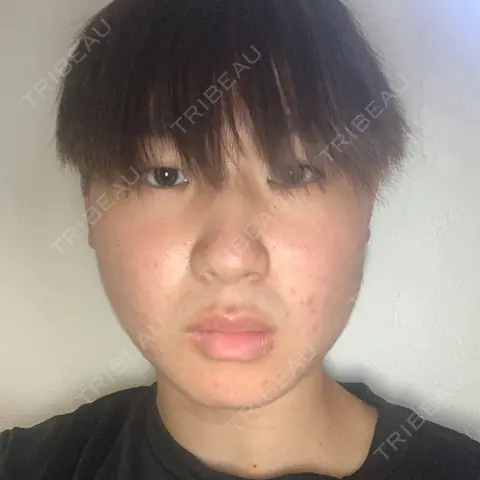 脂肪溶解注射（顔） MSC LUNA CLINIC 渋谷院 AFTER