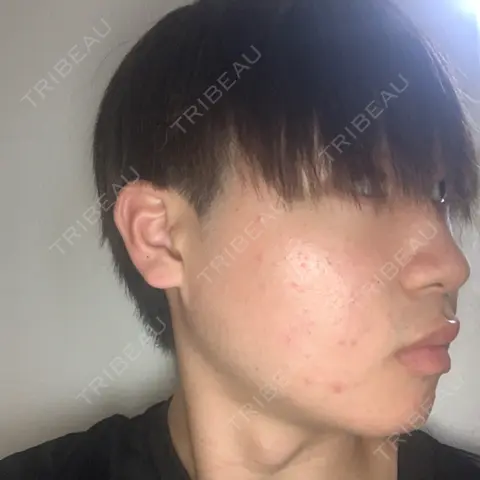 脂肪溶解注射（顔） MSC LUNA CLINIC 渋谷院 AFTER