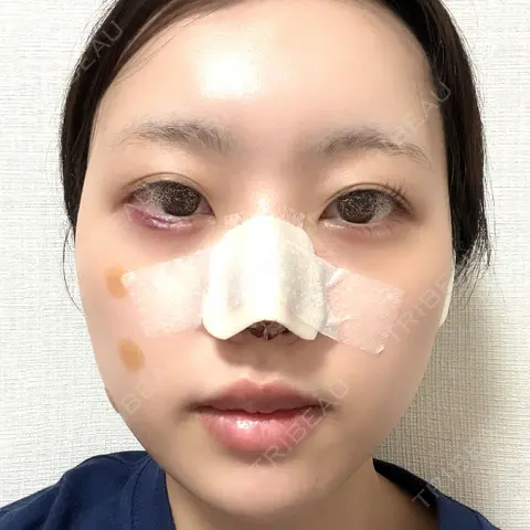 鼻尖形成（切開） / 軟骨移植 / ヒアルロン酸注入（涙袋） / ヒアルロン酸注入（唇） / ボトックス（口角） / ヒアルロン酸注入（額） 東京シンデレラ美容外科 池袋院 DAY 1