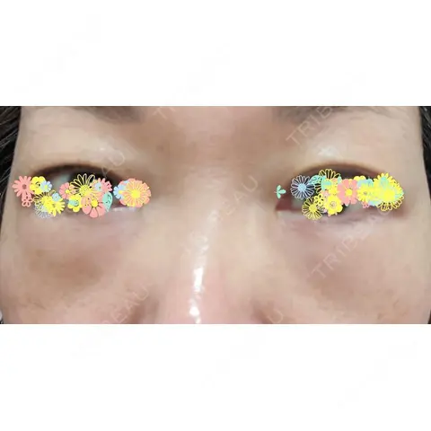 クマ治療 / 下まぶたの脂肪取り 東郷美容形成外科 福岡 DAY 1