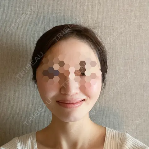 糸リフト oggi clinic AFTER
