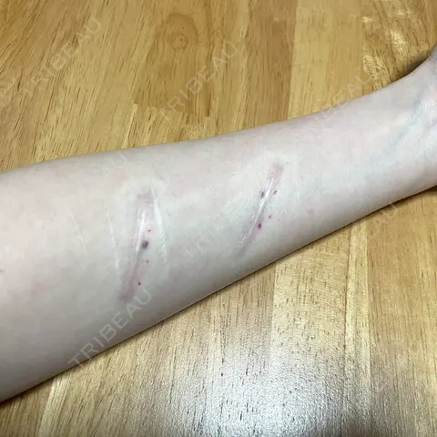 傷跡修正 郡山タウン形成外科クリニック DAY 0