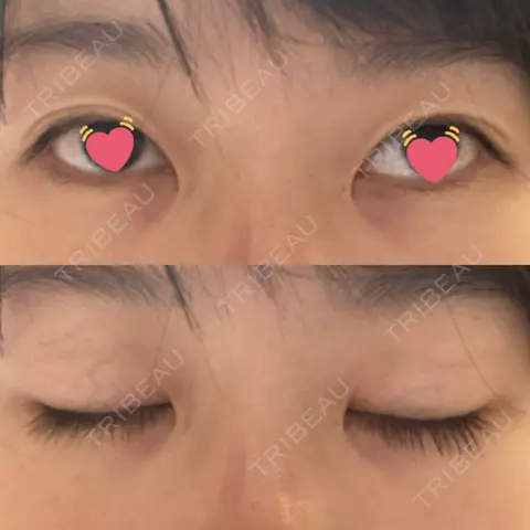 二重埋没 すなおクリニック AFTER