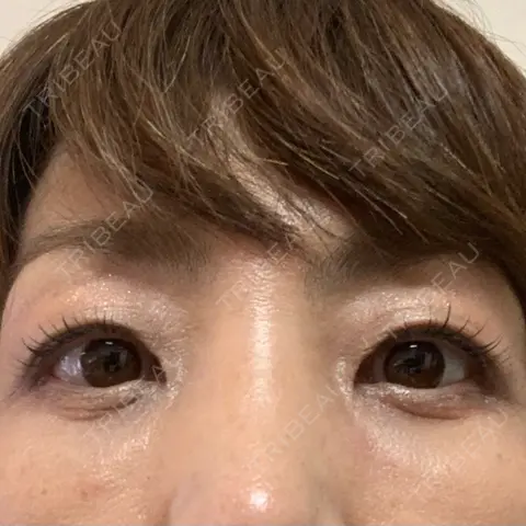 下まぶたたるみ取り / 下まぶたの脂肪取り / ヒアルロン酸注入（頬） 東郷美容形成外科 福岡 AFTER
