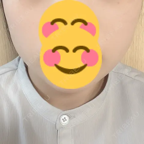 ボトックス（エラ・小顔） TCB東京中央美容外科 高崎院 DAY 1