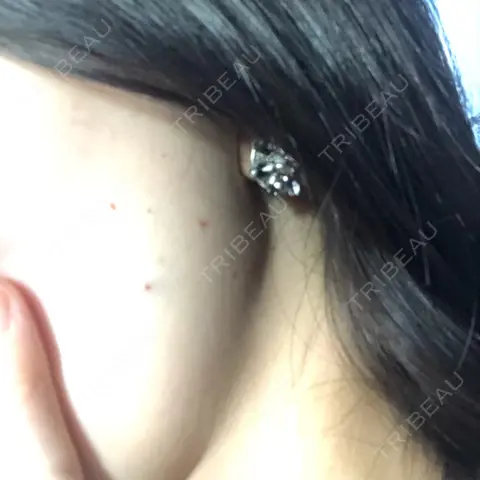 ボトックス（エラ・小顔） / 脂肪溶解注射（顔） あいちビューティークリニック AFTER
