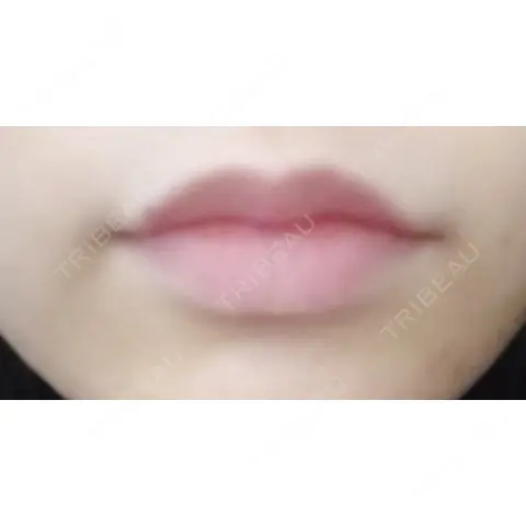 ヒアルロン酸注入（唇） クッキー整形外科 AFTER