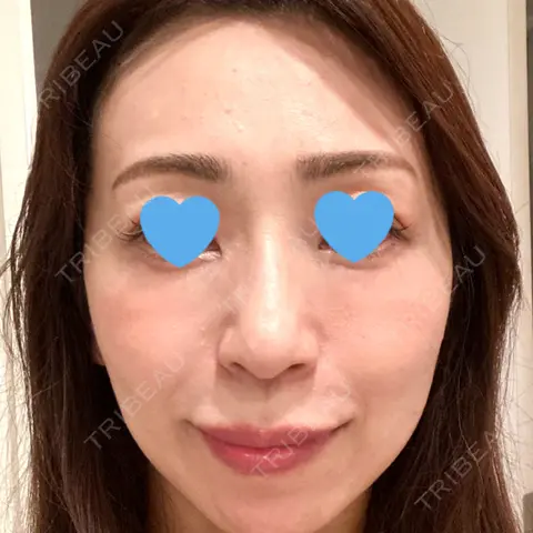 PRP皮膚再生療法 東京皮膚科・形成外科 (銀座いけだクリニック) AFTER