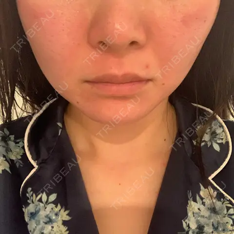 ピコレーザートーニング（美白・肝斑） / ピコフラクショナルレーザー（毛穴・ニキビ跡） NOVUSBeautyClinic 新宿ラウンジ DAY 0