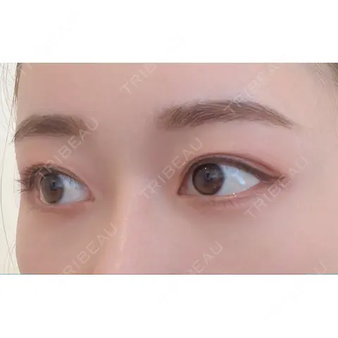 クマ治療 / 下まぶたの脂肪取り 心斎橋形成外科スキンケアクリニック AFTER