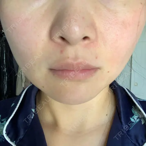 ピコレーザートーニング（美白・肝斑） / ピコフラクショナルレーザー（毛穴・ニキビ跡） NOVUSBeautyClinic 新宿ラウンジ AFTER