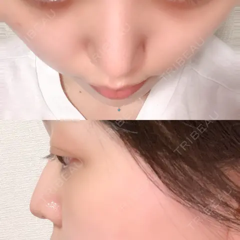 鼻尖形成（切開） / 軟骨移植 / ヒアルロン酸注入（涙袋） / ヒアルロン酸注入（唇） / ボトックス（口角） / ヒアルロン酸注入（額） 東京シンデレラ美容外科 池袋院 AFTER