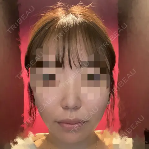 隆鼻術 / メーラーファット除去 / ジョールファット除去 ASTRA BEAUTY CLINIC AFTER