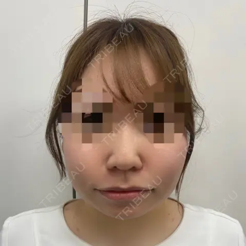 隆鼻術 / メーラーファット除去 / ジョールファット除去 ASTRA BEAUTY CLINIC AFTER