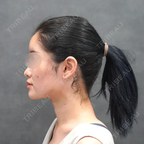 脂肪吸引（顔） / 脂肪注入（額） / 脂肪注入（輪郭） ヴェルトラクリニック 大阪院 DAY 1