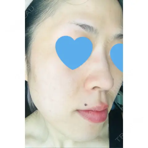 ピーリング（ニキビ・毛穴） / イオン導入 / フォトシルクプラス / 光治療（フォトフェイシャルなど） / ウーバーピール / ニキビ治療 / その他（肌） ハニークリニック AFTER