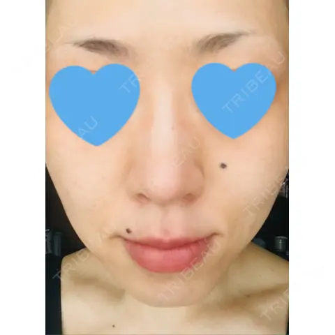 ピーリング（ニキビ・毛穴） / イオン導入 / フォトシルクプラス / 光治療（フォトフェイシャルなど） / ウーバーピール / ニキビ治療 / その他（肌） ハニークリニック AFTER