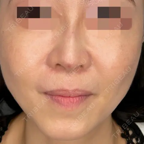 隆鼻術 / 糸リフト / 鼻尖縮小 ASTRA BEAUTY CLINIC AFTER