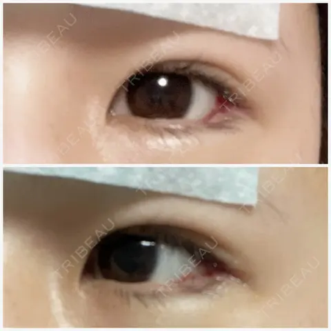 目尻切開 / タレ目形成・グラマラスライン（埋没） A CLINIC（エークリニック） 銀座院 DAY 0
