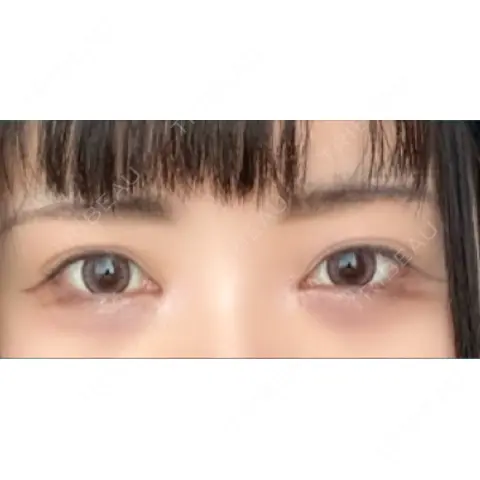 二重埋没 / 目頭切開 / 鼻尖形成（切開） / 小鼻縮小（切開） / クマ治療 / 小鼻縮小（非切開） / その他（鼻） YBC横浜美容外科 大宮院 AFTER