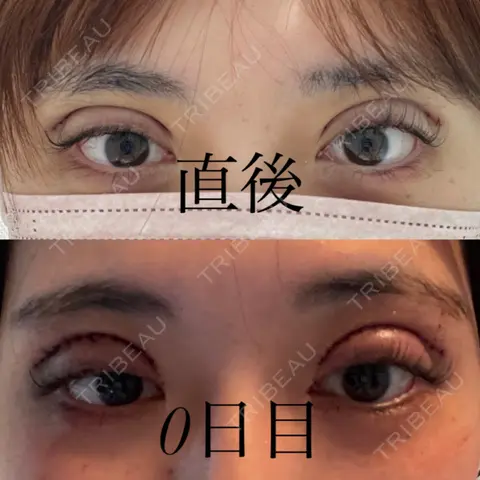 二重切開 / 上まぶたの脂肪取り オーキッド美容クリニック東京御徒町 DAY 0