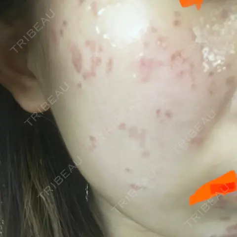 シミ取りレーザー Olino美容外科・美容皮膚科 DAY 2