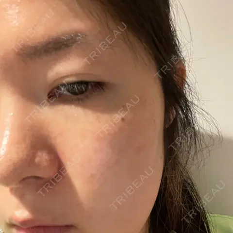 光治療（フォトフェイシャルなど） 椿クリニック 心斎橋院 AFTER