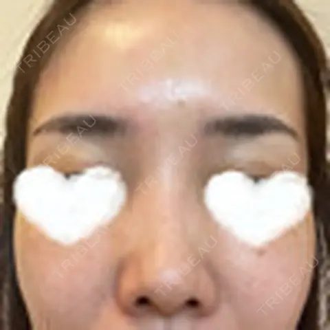 フォトRF / 光治療（フォトフェイシャルなど） 湘南美容クリニック 岡山院 AFTER