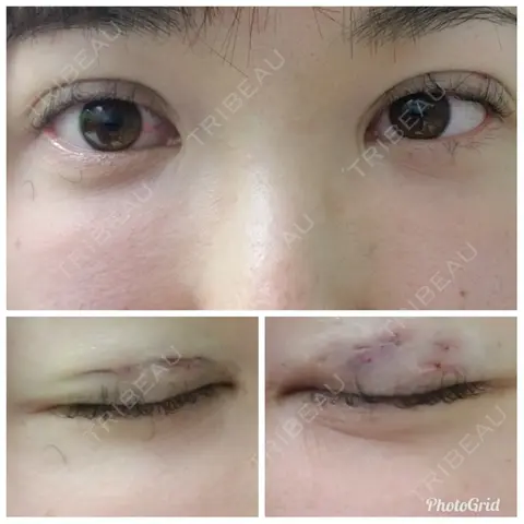 二重埋没 アロマ美容外科クリニック DAY 0