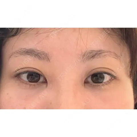 クマ治療 EMMO FACE CLINIC 大宮院 AFTER