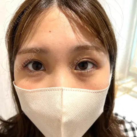 二重埋没 BELINDA CLINIC（ベリンダクリニック）新宿院 DAY 0