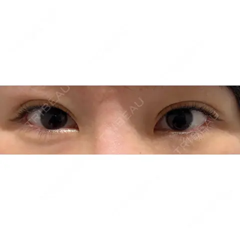 二重埋没 BELINDA CLINIC（ベリンダクリニック）新宿院 DAY 0