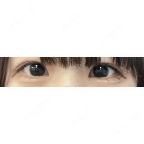目尻切開 / タレ目形成・グラマラスライン（埋没） A CLINIC（エークリニック） 銀座院 AFTER