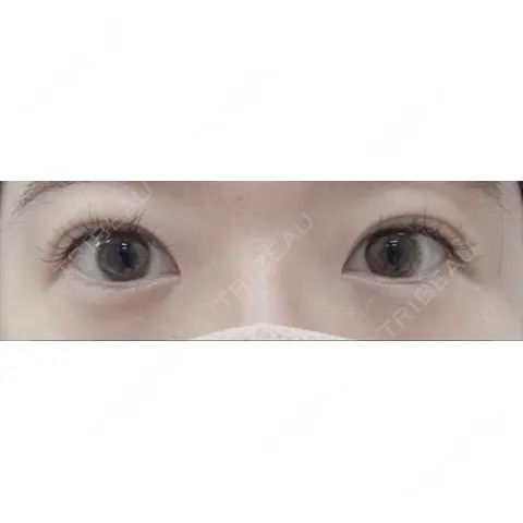 ハイフ（顔） ロナロナクリニック AFTER
