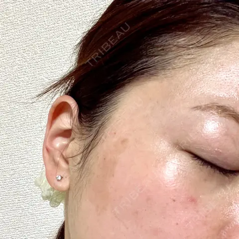 ピコレーザートーニング（美白・肝斑） NOVUSBeautyClinic 新宿ラウンジ AFTER