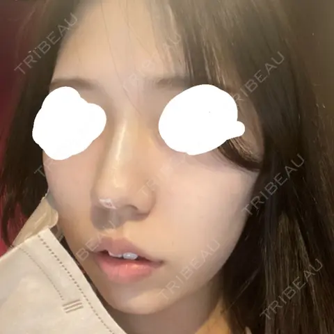 隆鼻術 / ヒアルロン酸注入（あご） / ボトックス（エラ・小顔） ASTRA BEAUTY CLINIC AFTER