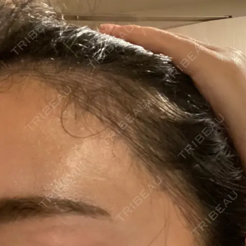 アートメイク（ヘアライン） トイトイトイクリニック 池袋院 DAY 0