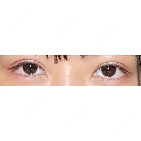 二重切開 サラ美容外科 AFTER