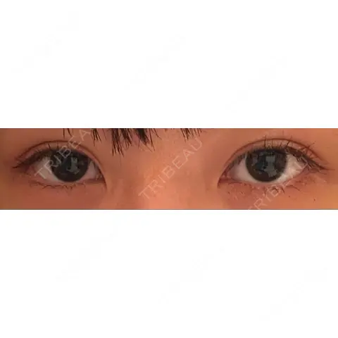 二重切開 サラ美容外科 AFTER