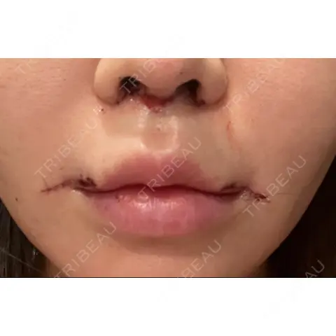 人中短縮 / 口角挙上 / ボトックス（口角） / ボトックス（人中） / その他（口元） eクリニック 金沢本院 DAY 0